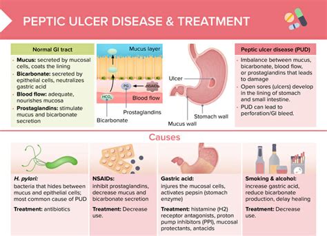 Peptic Ulcers Treatments