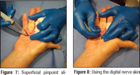 Percutaneous needle fasciotomy for Dupuytren's contracture