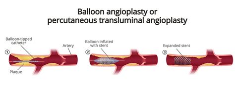 Percutaneous Transluminal Angioplasty Procedure