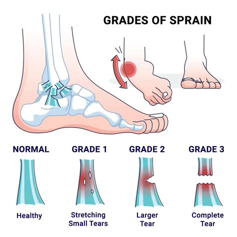 Physical Therapy for Ankle Injuries