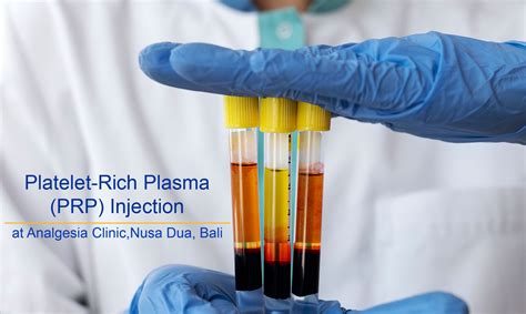 Platelet-Rich Plasma Therapy