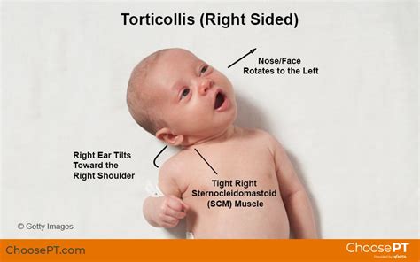 Positioning Techniques for Torticollis