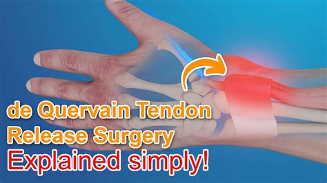 Preparation for De Quervain's Tenosynovitis Surgery