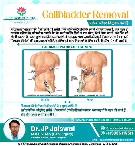Preparation for Gallstone Removal Surgery