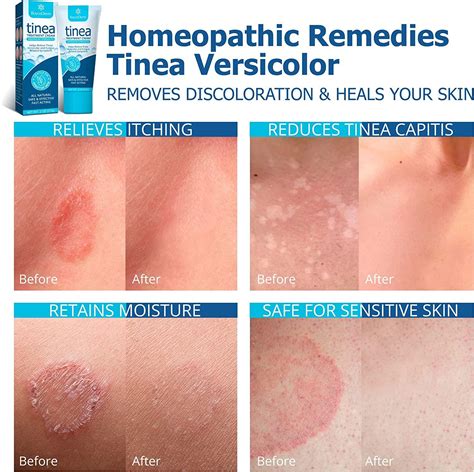 Prescription Treatments for Ringworm