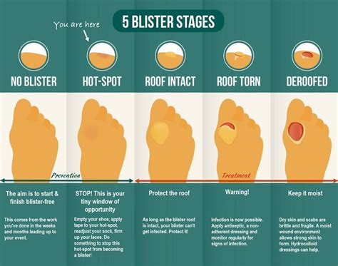Preventing Blisters On Feet