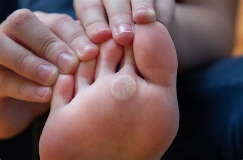 Preventing Plantar Warts