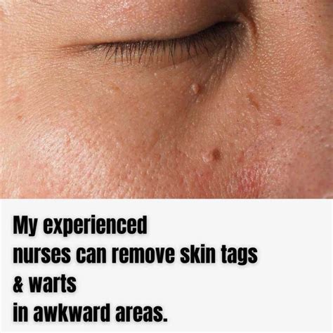 Preventing Skin Tags
