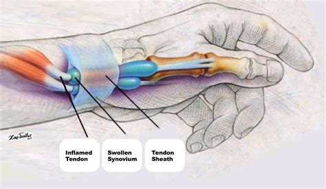 Prevention and Management of De Quervain Syndrome