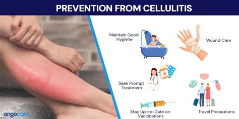 Prevention of cellulitis