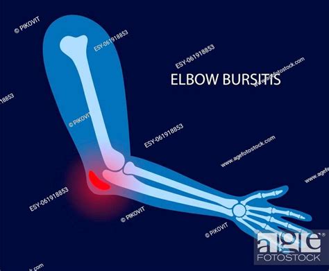 Prevention of Elbow Bursitis