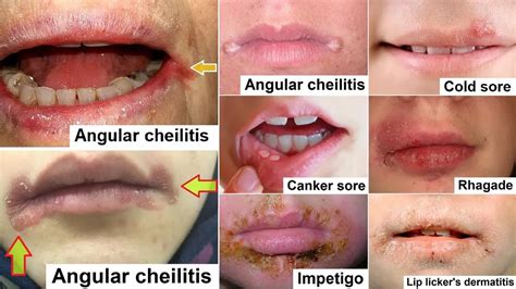 Prevention of Angular Stomatitis