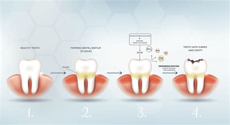 Prevention of Dental Plaque