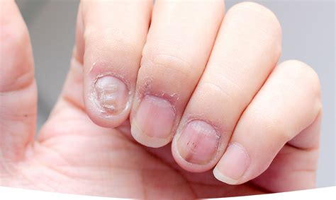 Prevention of Fingernail Loss