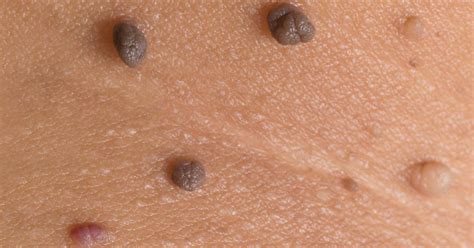 Prevention of Moles and Skin Tags