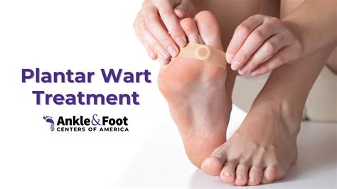 Prevention of Plantar Warts