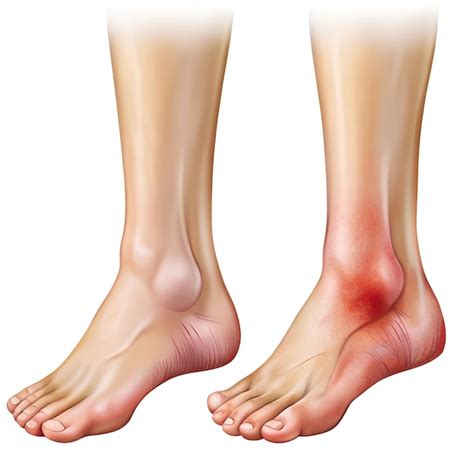 Prevention of Swollen Ankles During Pregnancy