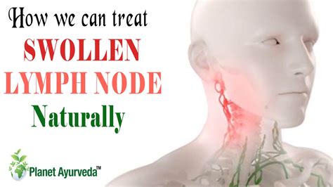 Prevention of Swollen Lymph Nodes