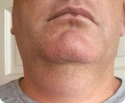 Prevention of Swollen Lymph Nodes Under the Jaw