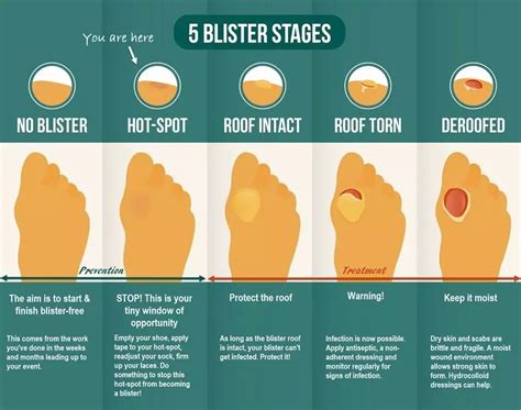 Prevention of Toe Blisters