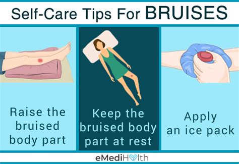 Preventive Measures for Bruising