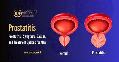 Causes of Prostatitis