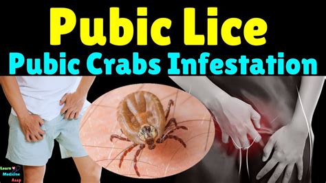Pubic Lice Removal Methods