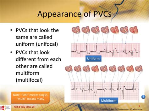 Pvcs Causes