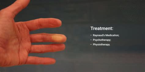 Raynaud's Phenomenon Treatment