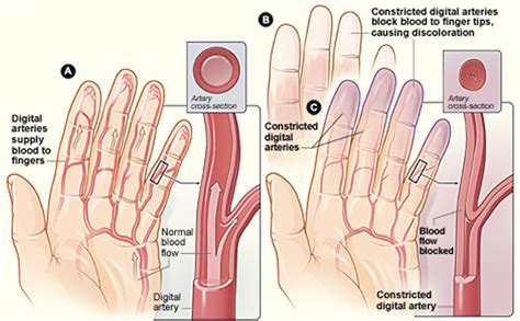 Raynaud's Syndrome Causes