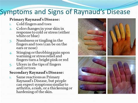 Raynaud's Syndrome Diagnosis