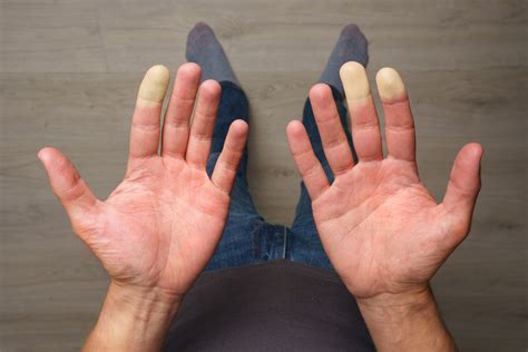 Raynaud's Syndrome Living