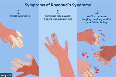 Raynaud's Syndrome Symptoms