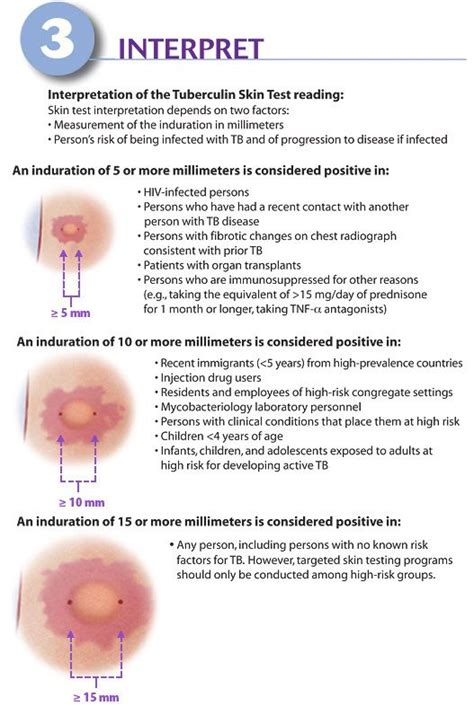 Reading Mantoux Test