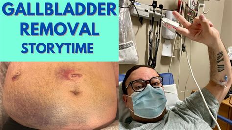 Recovery After Gallstone Removal Surgery