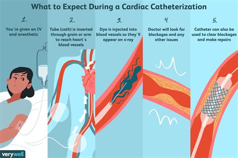 Recovery After Left Heart Cath Procedure