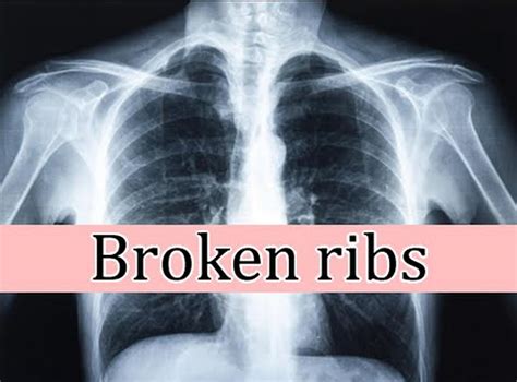 Recovery Time and Prognosis for Bruised Ribs