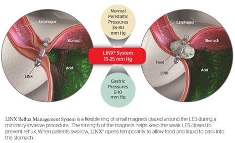 Recovery and Follow-up After Reflux Surgery