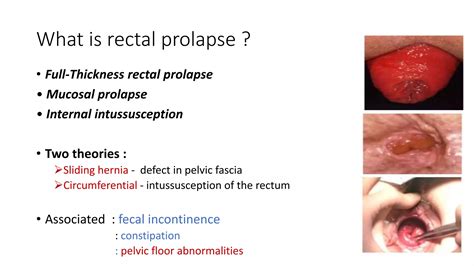 Rectal Prolapse