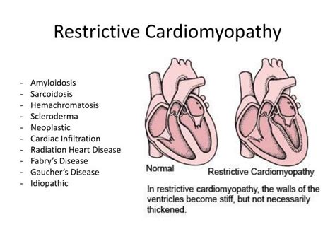 Restrictive Cardiomyopathy