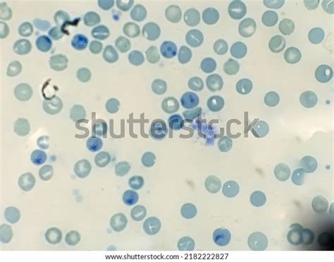 Reticular Site Count and Lymphoma