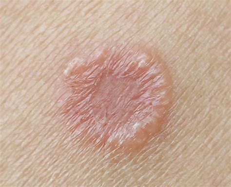 Ringworm