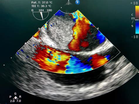Risks and Complications of Transesophageal Echocardiogram
