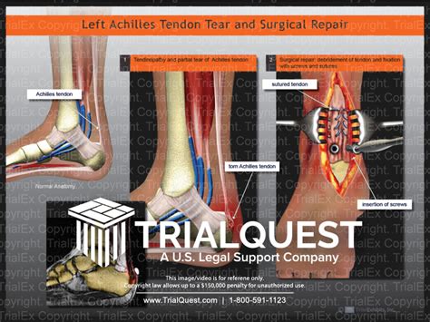 Risks and Complications of Achilles Tendon Repair Surgery