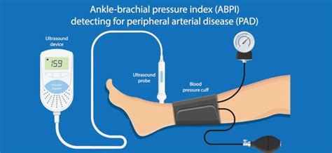 Risks and Complications of Ankle Brachial Index Test