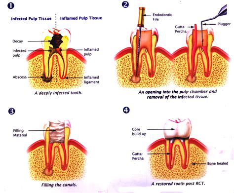 Root Canal Surgery