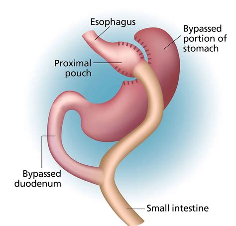 Roux En Y Gastric Bypass Surgery