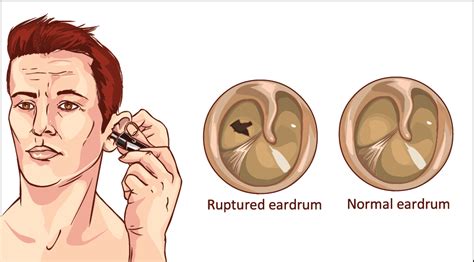 Ruptured Eardrum Causes