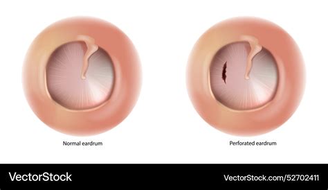 Ruptured Eardrum FAQ