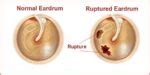 Ruptured Eardrum Final Thoughts
